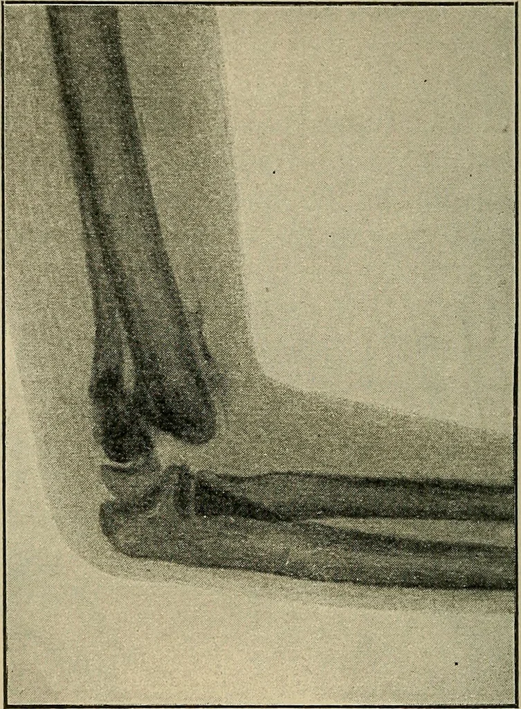 An illustration from Atlas and epitome of traumatic fractures and dislocations / by H. Helferich ; auth. tr. from the German, ed. by Joseph C. Bloodgood., 1902, leaf 258