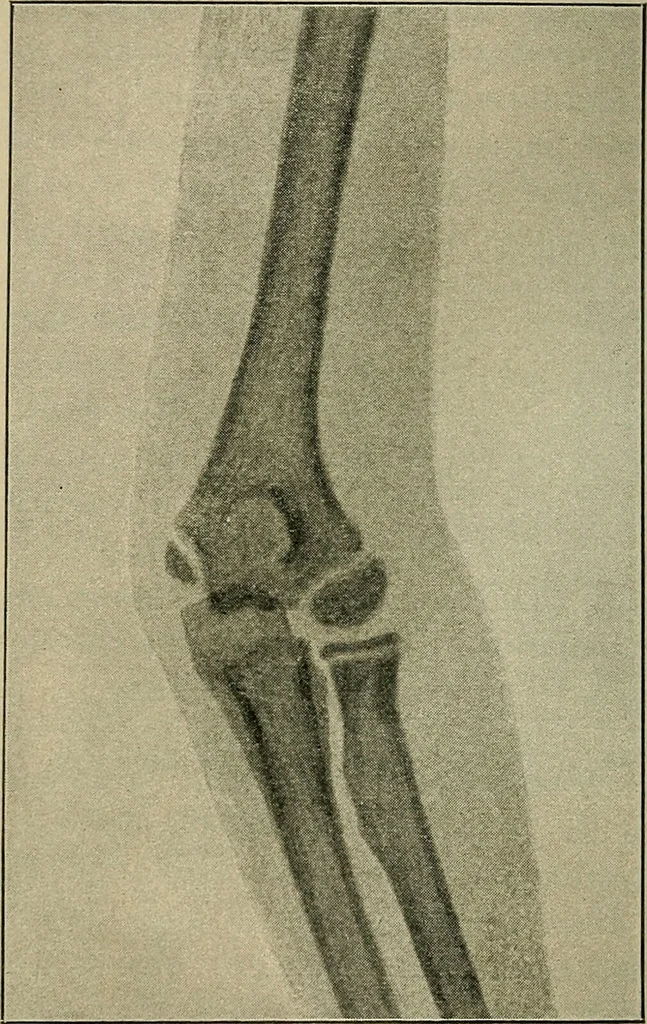 An illustration from Atlas and epitome of traumatic fractures and dislocations / by H. Helferich ; auth. tr. from the German, ed. by Joseph C. Bloodgood., 1902, leaf 262