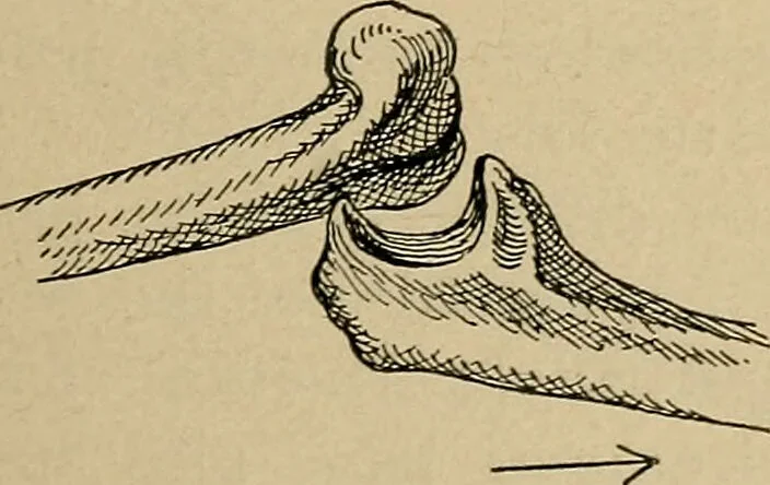 An illustration from Atlas and epitome of traumatic fractures and dislocations / by H. Helferich ; auth. tr. from the German, ed. by Joseph C. Bloodgood., 1902, leaf 275