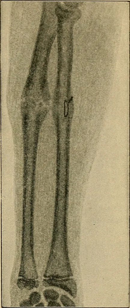 An illustration from Atlas and epitome of traumatic fractures and dislocations / by H. Helferich ; auth. tr. from the German, ed. by Joseph C. Bloodgood., 1902, leaf 285