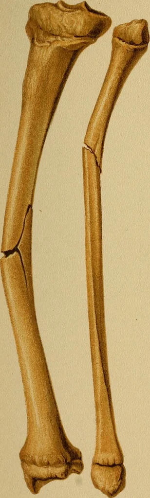 An illustration from Atlas and epitome of traumatic fractures and dislocations / by H. Helferich ; auth. tr. from the German, ed. by Joseph C. Bloodgood., 1902, leaf 29