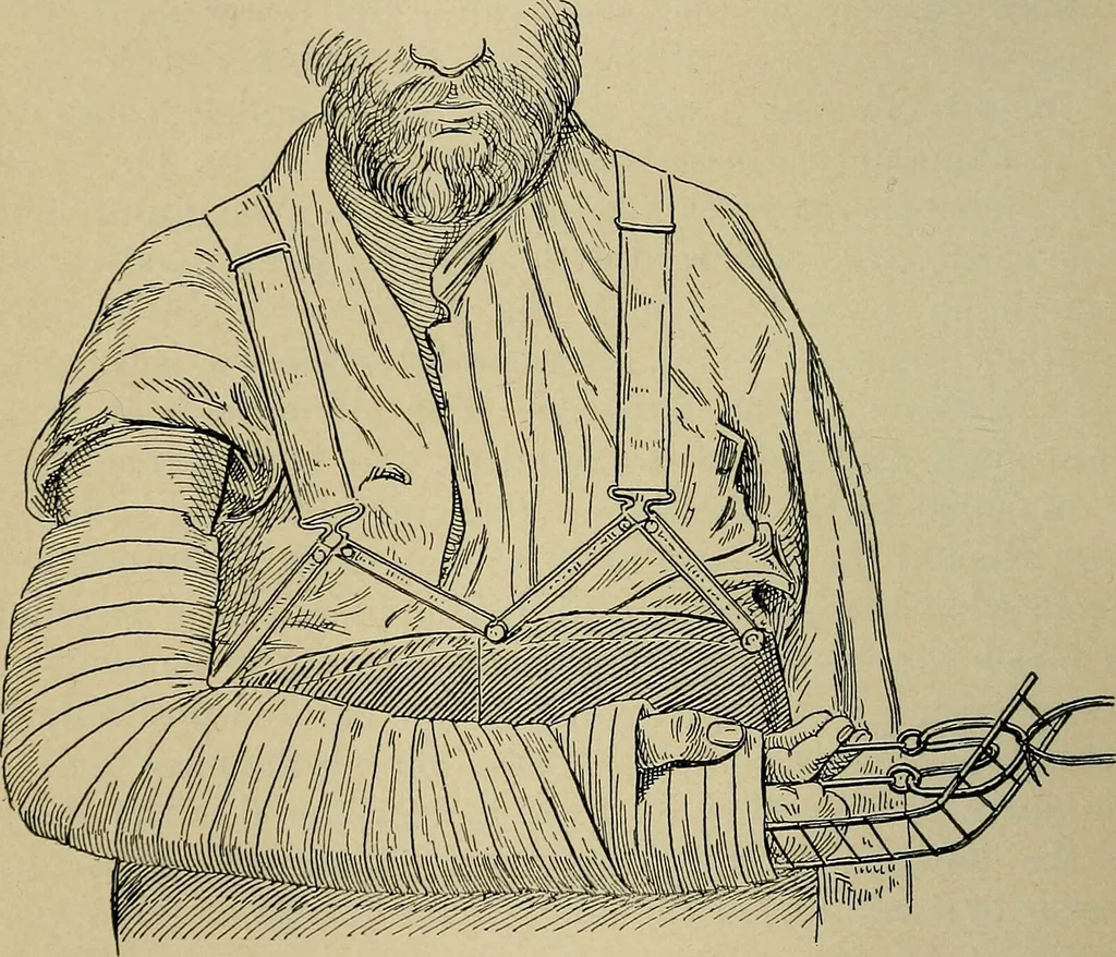 An illustration from Atlas and epitome of traumatic fractures and dislocations / by H. Helferich ; auth. tr. from the German, ed. by Joseph C. Bloodgood., 1902, leaf 294