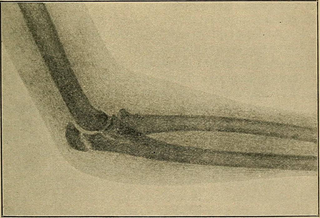 An illustration from Atlas and epitome of traumatic fractures and dislocations / by H. Helferich ; auth. tr. from the German, ed. by Joseph C. Bloodgood., 1902, leaf 299