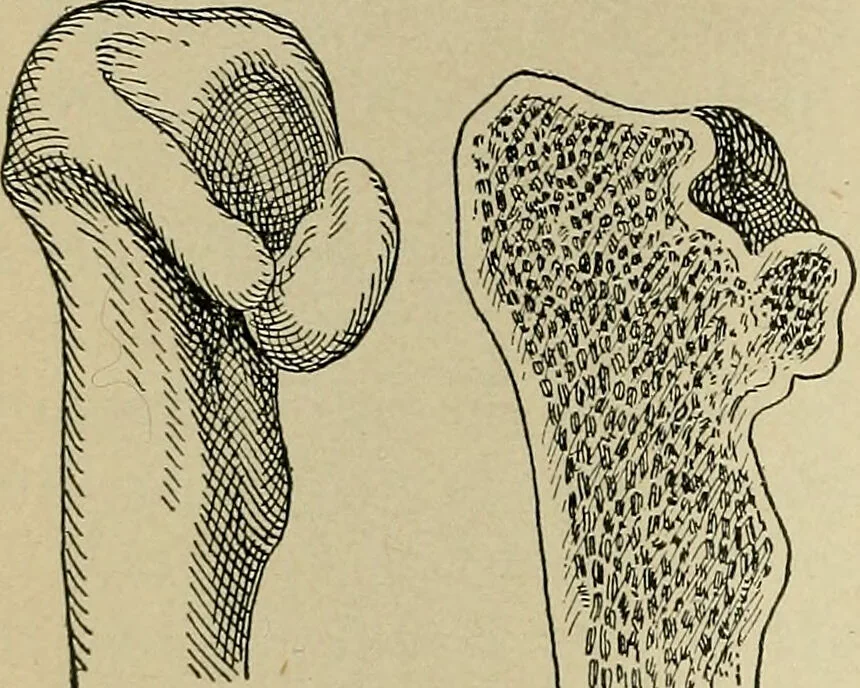 An illustration from Atlas and epitome of traumatic fractures and dislocations / by H. Helferich ; auth. tr. from the German, ed. by Joseph C. Bloodgood., 1902, leaf 308