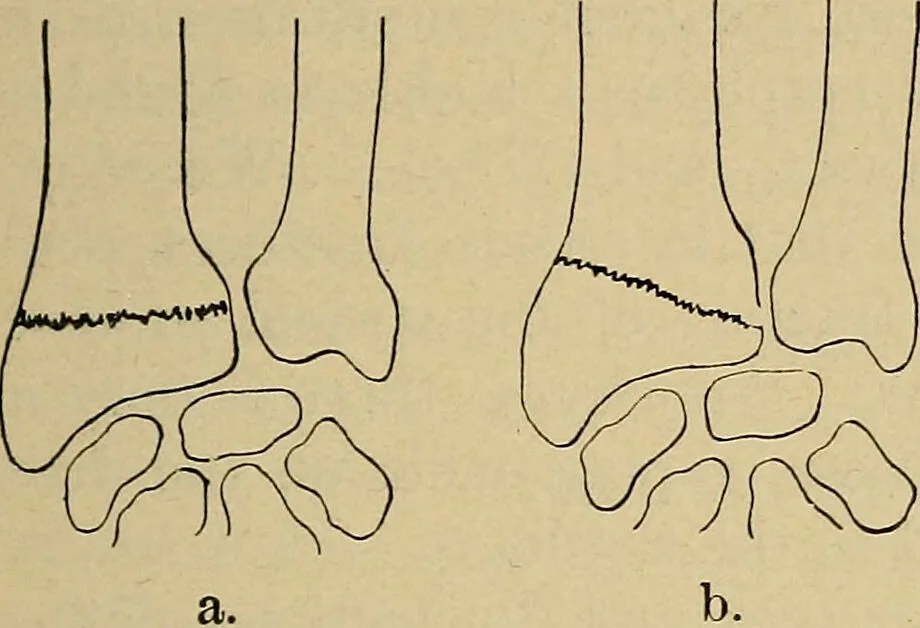 An illustration from Atlas and epitome of traumatic fractures and dislocations / by H. Helferich ; auth. tr. from the German, ed. by Joseph C. Bloodgood., 1902, leaf 313