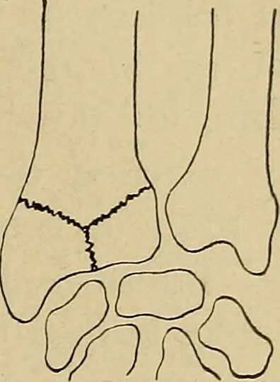 An illustration from Atlas and epitome of traumatic fractures and dislocations / by H. Helferich ; auth. tr. from the German, ed. by Joseph C. Bloodgood., 1902, leaf 313