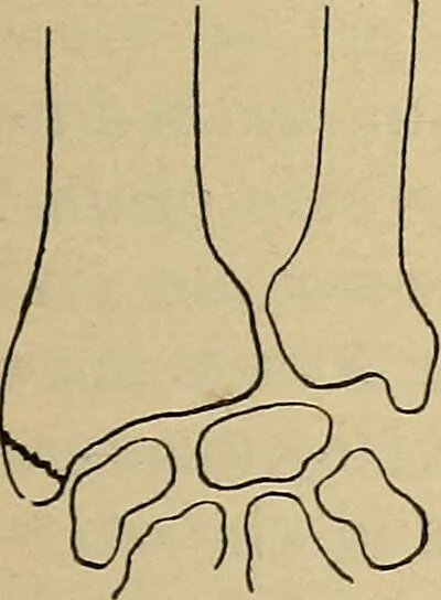 An illustration from Atlas and epitome of traumatic fractures and dislocations / by H. Helferich ; auth. tr. from the German, ed. by Joseph C. Bloodgood., 1902, leaf 313