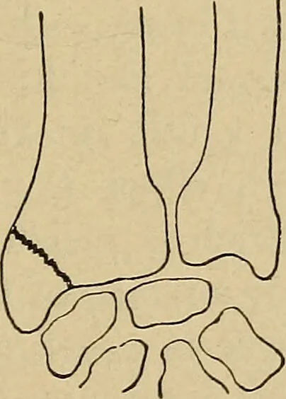 An illustration from Atlas and epitome of traumatic fractures and dislocations / by H. Helferich ; auth. tr. from the German, ed. by Joseph C. Bloodgood., 1902, leaf 313