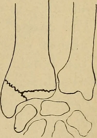An illustration from Atlas and epitome of traumatic fractures and dislocations / by H. Helferich ; auth. tr. from the German, ed. by Joseph C. Bloodgood., 1902, leaf 313