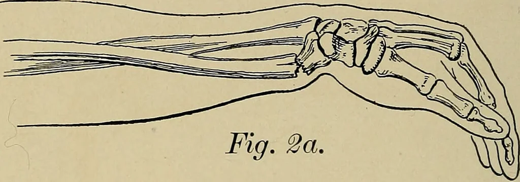 An illustration from Atlas and epitome of traumatic fractures and dislocations / by H. Helferich ; auth. tr. from the German, ed. by Joseph C. Bloodgood., 1902, leaf 322