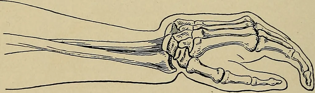 An illustration from Atlas and epitome of traumatic fractures and dislocations / by H. Helferich ; auth. tr. from the German, ed. by Joseph C. Bloodgood., 1902, leaf 322