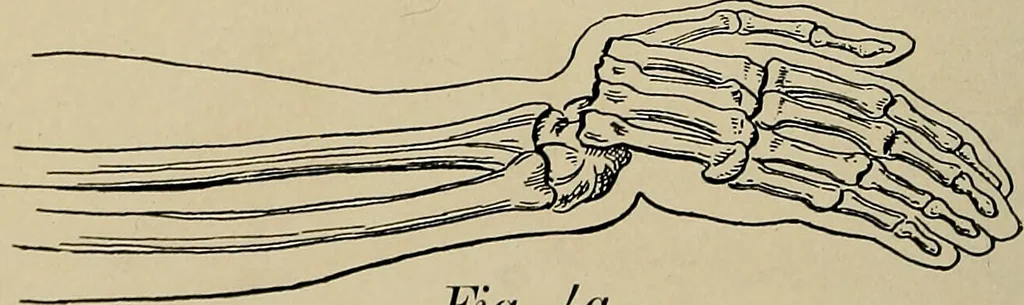 An illustration from Atlas and epitome of traumatic fractures and dislocations / by H. Helferich ; auth. tr. from the German, ed. by Joseph C. Bloodgood., 1902, leaf 322