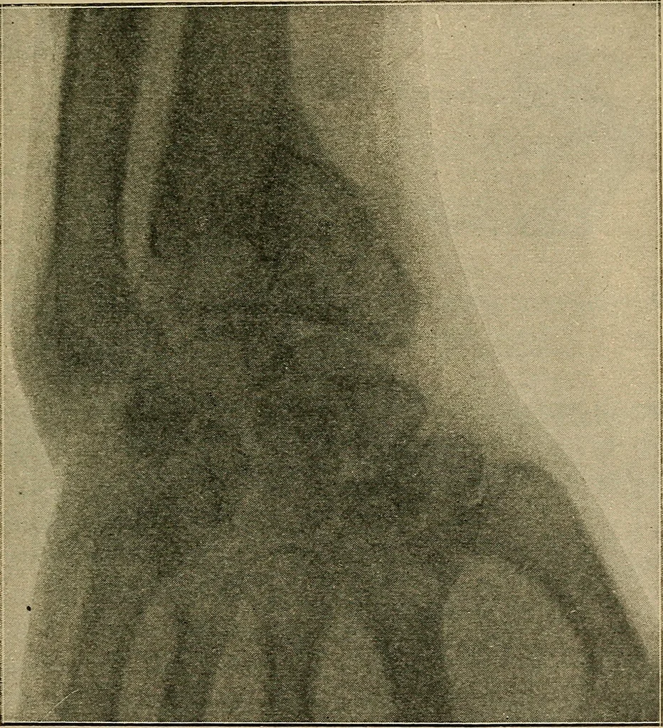 An illustration from Atlas and epitome of traumatic fractures and dislocations / by H. Helferich ; auth. tr. from the German, ed. by Joseph C. Bloodgood., 1902, leaf 323