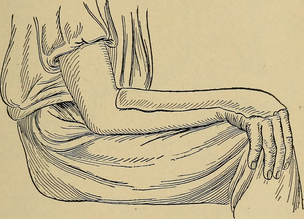 An illustration from Atlas and epitome of traumatic fractures and dislocations / by H. Helferich ; auth. tr. from the German, ed. by Joseph C. Bloodgood., 1902, leaf 325