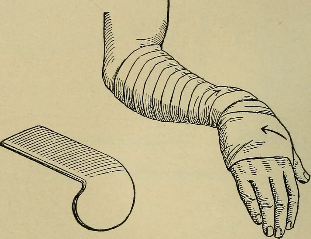 An illustration from Atlas and epitome of traumatic fractures and dislocations / by H. Helferich ; auth. tr. from the German, ed. by Joseph C. Bloodgood., 1902, leaf 326