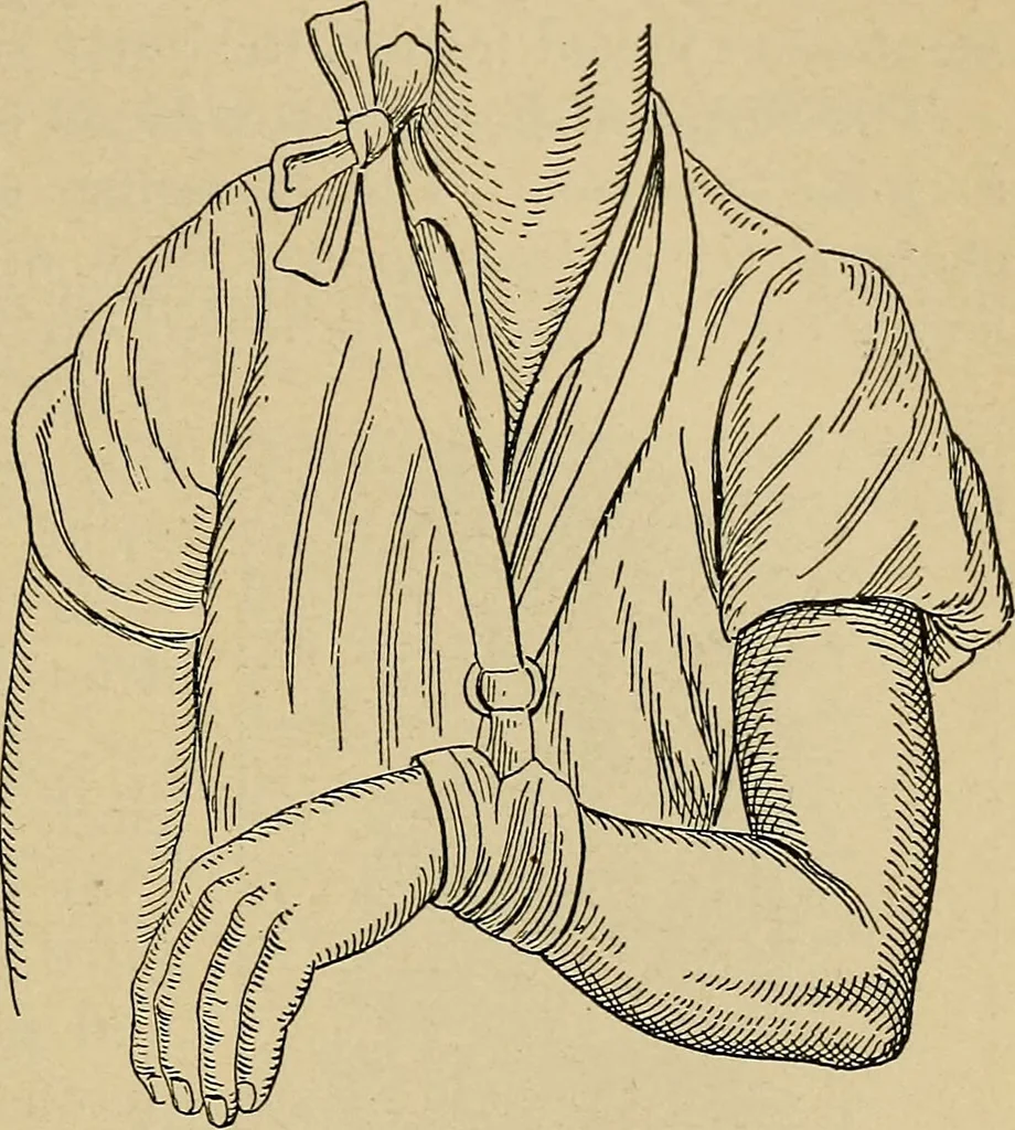 An illustration from Atlas and epitome of traumatic fractures and dislocations / by H. Helferich ; auth. tr. from the German, ed. by Joseph C. Bloodgood., 1902, leaf 327