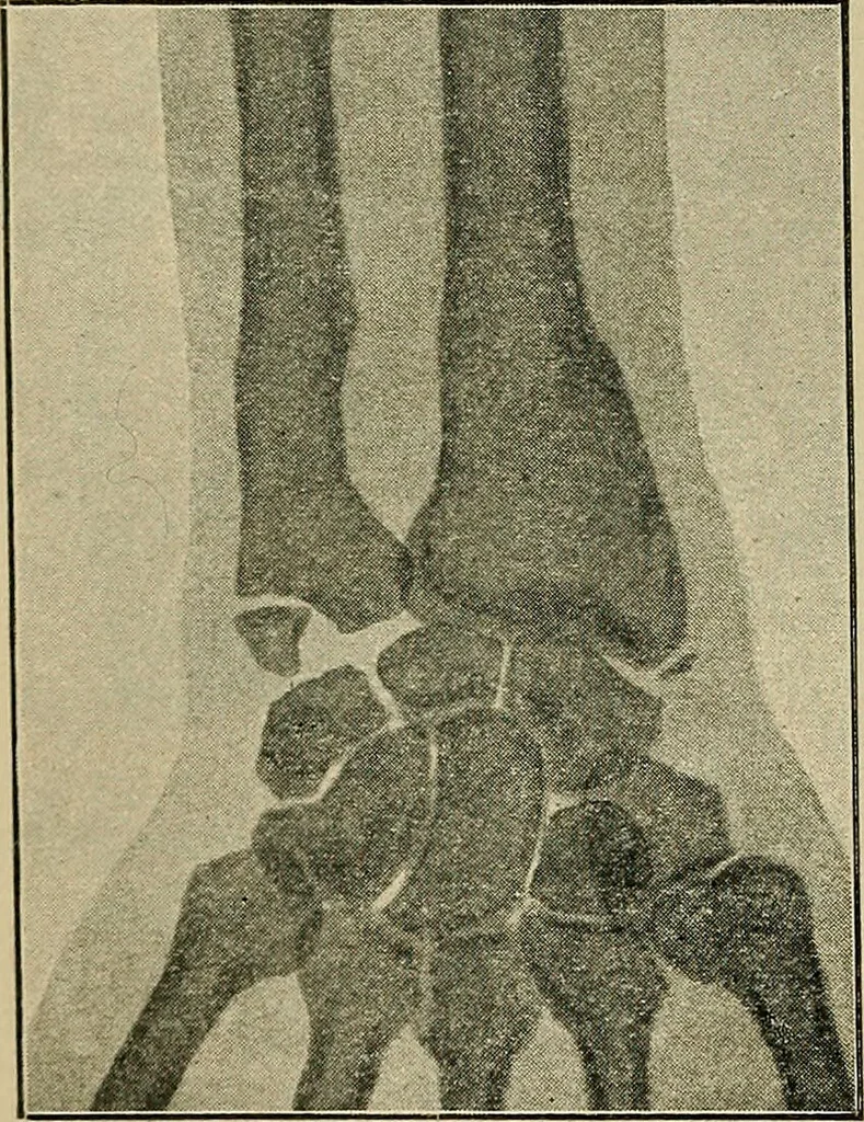 An illustration from Atlas and epitome of traumatic fractures and dislocations / by H. Helferich ; auth. tr. from the German, ed. by Joseph C. Bloodgood., 1902, leaf 328