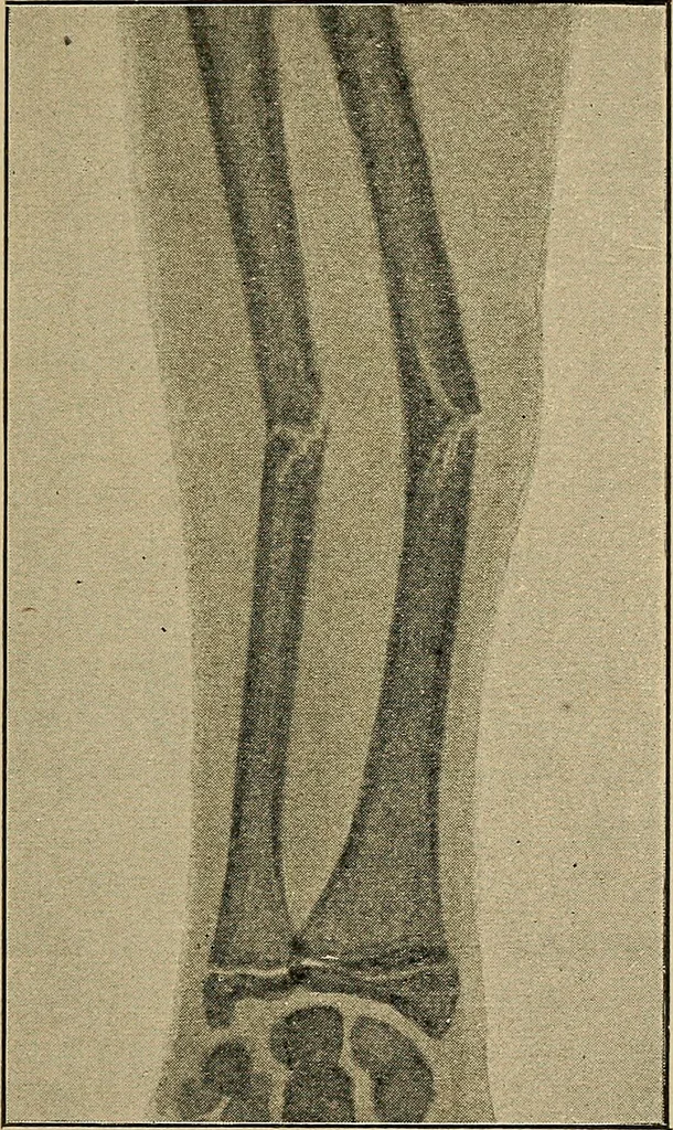 An illustration from Atlas and epitome of traumatic fractures and dislocations / by H. Helferich ; auth. tr. from the German, ed. by Joseph C. Bloodgood., 1902, leaf 33
