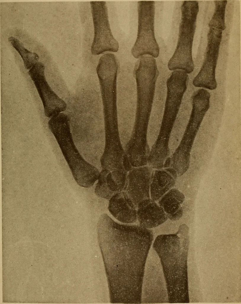 An illustration from Atlas and epitome of traumatic fractures and dislocations / by H. Helferich ; auth. tr. from the German, ed. by Joseph C. Bloodgood., 1902, leaf 331