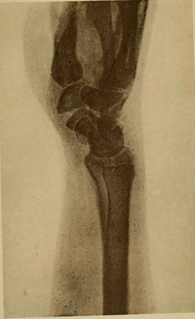 An illustration from Atlas and epitome of traumatic fractures and dislocations / by H. Helferich ; auth. tr. from the German, ed. by Joseph C. Bloodgood., 1902, leaf 335