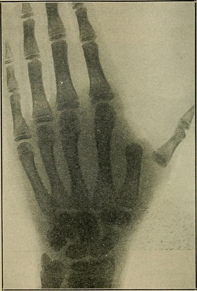 An illustration from Atlas and epitome of traumatic fractures and dislocations / by H. Helferich ; auth. tr. from the German, ed. by Joseph C. Bloodgood., 1902, leaf 338