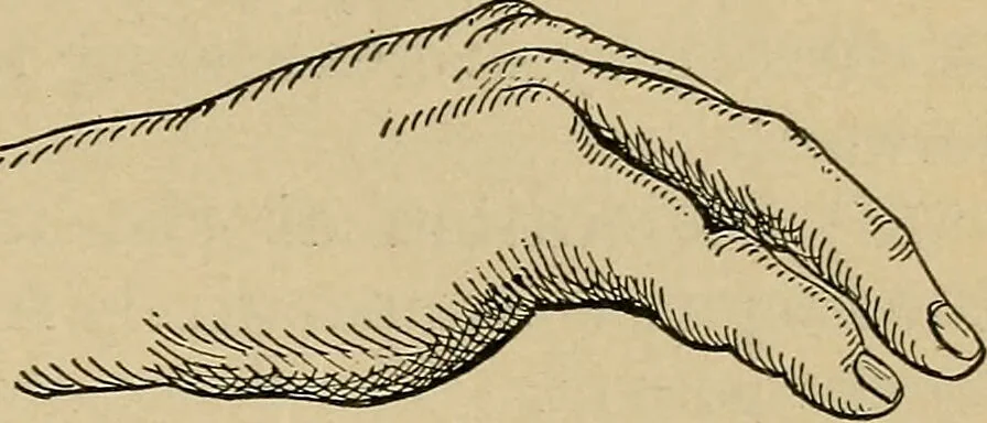An illustration from Atlas and epitome of traumatic fractures and dislocations / by H. Helferich ; auth. tr. from the German, ed. by Joseph C. Bloodgood., 1902, leaf 345