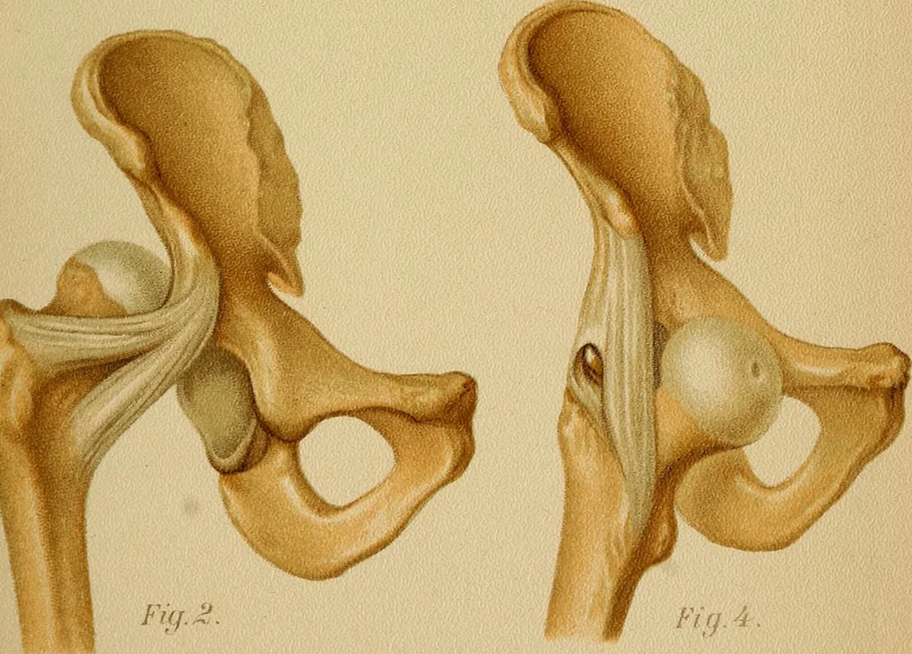 An illustration from Atlas and epitome of traumatic fractures and dislocations / by H. Helferich ; auth. tr. from the German, ed. by Joseph C. Bloodgood., 1902, leaf 363