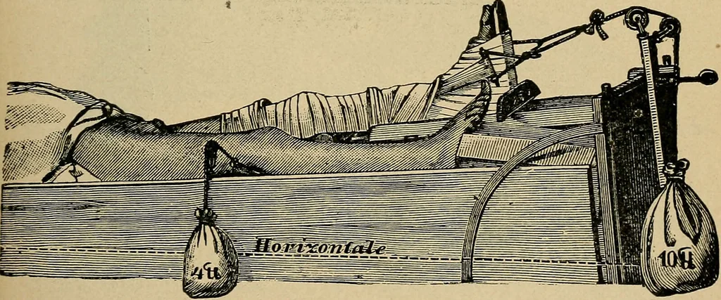 An illustration from Atlas and epitome of traumatic fractures and dislocations / by H. Helferich ; auth. tr. from the German, ed. by Joseph C. Bloodgood., 1902, leaf 401