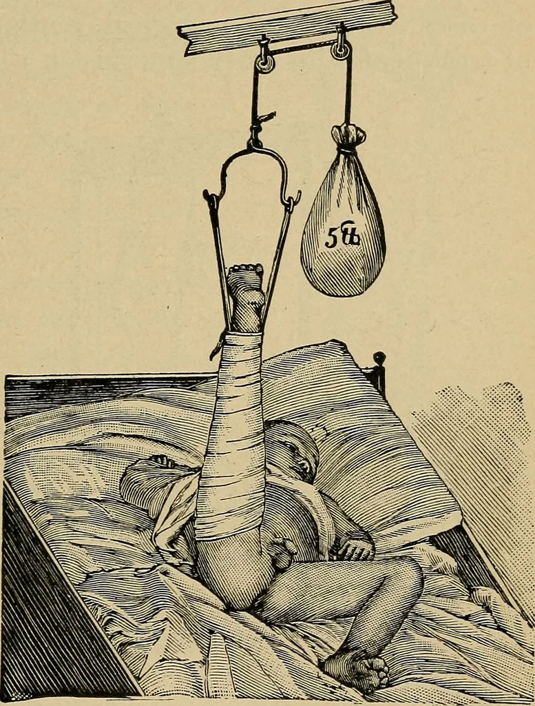 An illustration from Atlas and epitome of traumatic fractures and dislocations / by H. Helferich ; auth. tr. from the German, ed. by Joseph C. Bloodgood., 1902, leaf 405