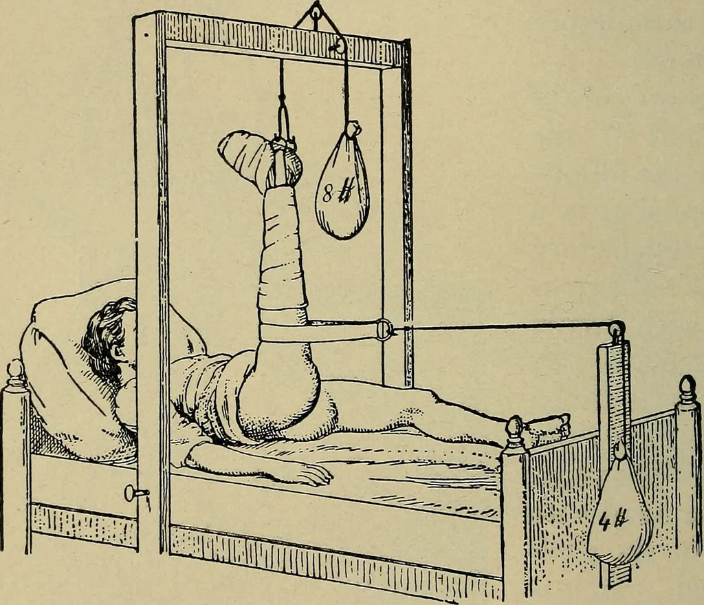 An illustration from Atlas and epitome of traumatic fractures and dislocations / by H. Helferich ; auth. tr. from the German, ed. by Joseph C. Bloodgood., 1902, leaf 406
