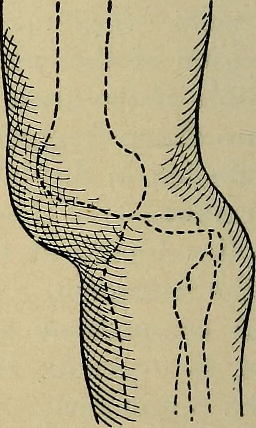 An illustration from Atlas and epitome of traumatic fractures and dislocations / by H. Helferich ; auth. tr. from the German, ed. by Joseph C. Bloodgood., 1902, leaf 418