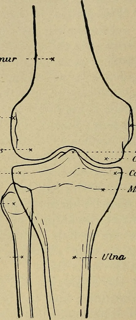 An illustration from Atlas and epitome of traumatic fractures and dislocations / by H. Helferich ; auth. tr. from the German, ed. by Joseph C. Bloodgood., 1902, leaf 434