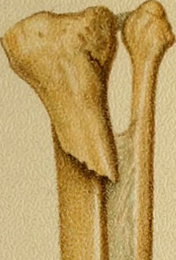 An illustration from Atlas and epitome of traumatic fractures and dislocations / by H. Helferich ; auth. tr. from the German, ed. by Joseph C. Bloodgood., 1902, leaf 455
