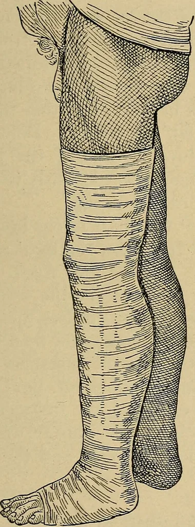 An illustration from Atlas and epitome of traumatic fractures and dislocations / by H. Helferich ; auth. tr. from the German, ed. by Joseph C. Bloodgood., 1902, leaf 459