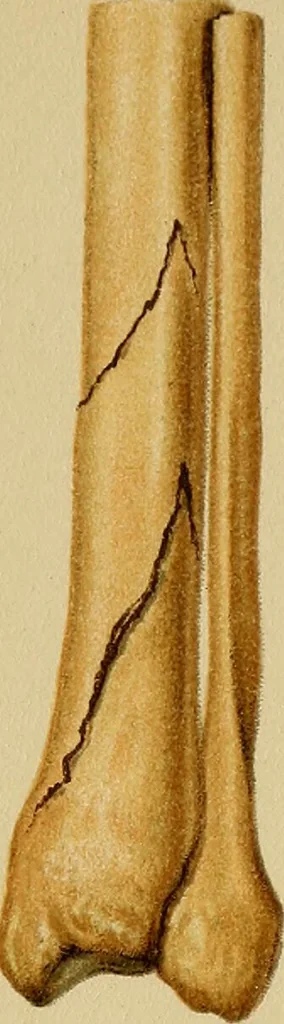An illustration from Atlas and epitome of traumatic fractures and dislocations / by H. Helferich ; auth. tr. from the German, ed. by Joseph C. Bloodgood., 1902, leaf 465
