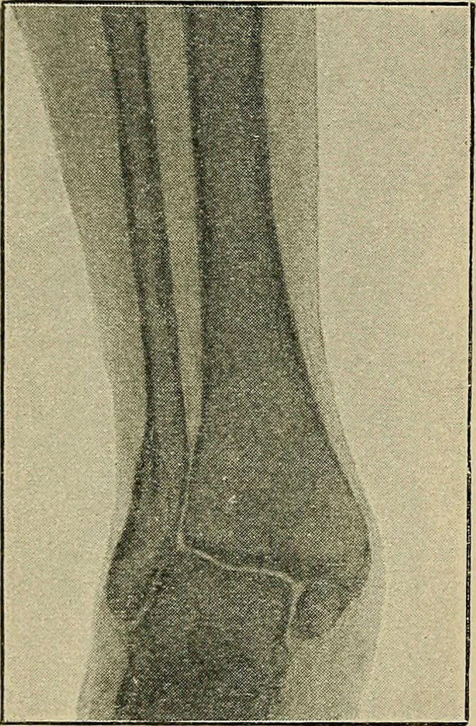 An illustration from Atlas and epitome of traumatic fractures and dislocations / by H. Helferich ; auth. tr. from the German, ed. by Joseph C. Bloodgood., 1902, leaf 476