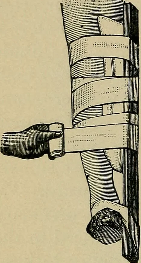 An illustration from Atlas and epitome of traumatic fractures and dislocations / by H. Helferich ; auth. tr. from the German, ed. by Joseph C. Bloodgood., 1902, leaf 478