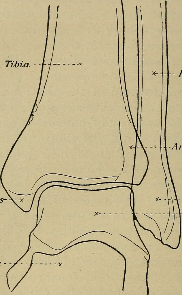 An illustration from Atlas and epitome of traumatic fractures and dislocations / by H. Helferich ; auth. tr. from the German, ed. by Joseph C. Bloodgood., 1902, leaf 480