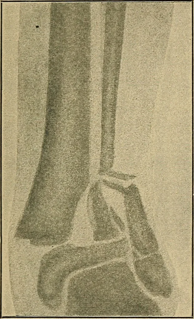 An illustration from Atlas and epitome of traumatic fractures and dislocations / by H. Helferich ; auth. tr. from the German, ed. by Joseph C. Bloodgood., 1902, leaf 483