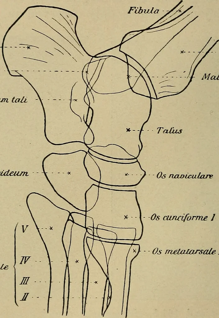 An illustration from Atlas and epitome of traumatic fractures and dislocations / by H. Helferich ; auth. tr. from the German, ed. by Joseph C. Bloodgood., 1902, leaf 484