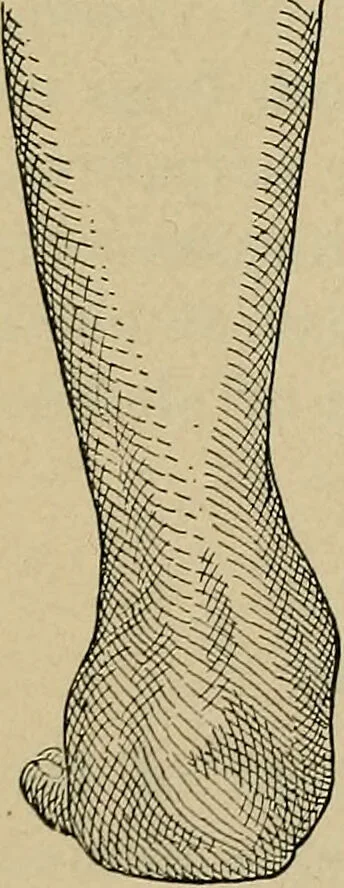 An illustration from Atlas and epitome of traumatic fractures and dislocations / by H. Helferich ; auth. tr. from the German, ed. by Joseph C. Bloodgood., 1902, leaf 492
