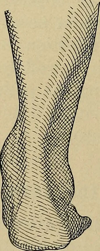 An illustration from Atlas and epitome of traumatic fractures and dislocations / by H. Helferich ; auth. tr. from the German, ed. by Joseph C. Bloodgood., 1902, leaf 492