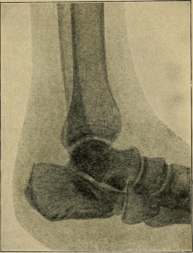 An illustration from Atlas and epitome of traumatic fractures and dislocations / by H. Helferich ; auth. tr. from the German, ed. by Joseph C. Bloodgood., 1902, leaf 493