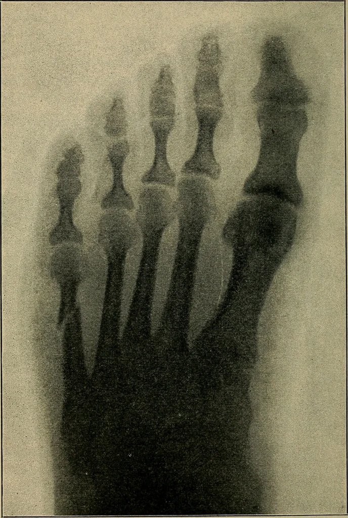 An illustration from Atlas and epitome of traumatic fractures and dislocations / by H. Helferich ; auth. tr. from the German, ed. by Joseph C. Bloodgood., 1902, leaf 496