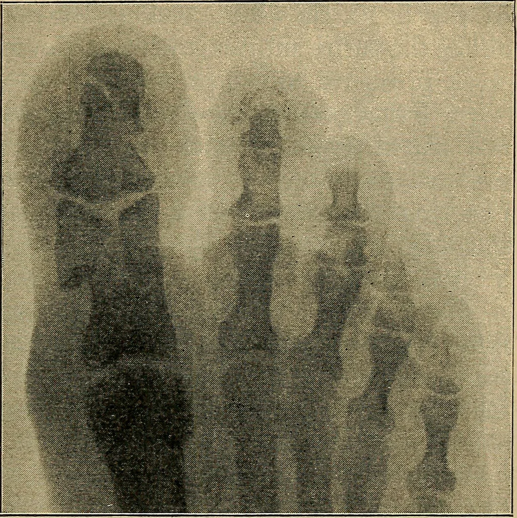 An illustration from Atlas and epitome of traumatic fractures and dislocations / by H. Helferich ; auth. tr. from the German, ed. by Joseph C. Bloodgood., 1902, leaf 497