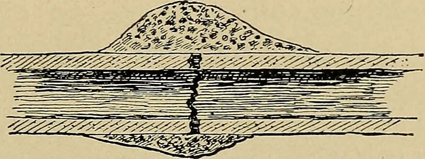 An illustration from Atlas and epitome of traumatic fractures and dislocations / by H. Helferich ; auth. tr. from the German, ed. by Joseph C. Bloodgood., 1902, leaf 63