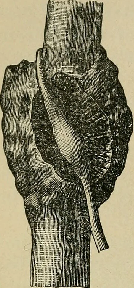 An illustration from Atlas and epitome of traumatic fractures and dislocations / by H. Helferich ; auth. tr. from the German, ed. by Joseph C. Bloodgood., 1902, leaf 74