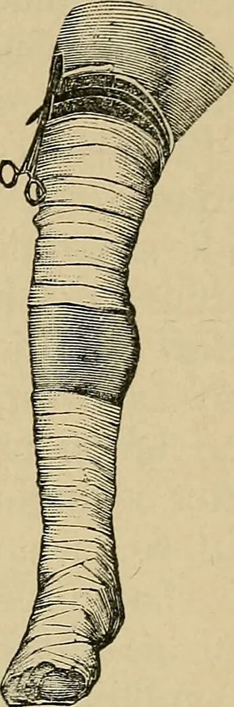 An illustration from Atlas and epitome of traumatic fractures and dislocations / by H. Helferich ; auth. tr. from the German, ed. by Joseph C. Bloodgood., 1902, leaf 75