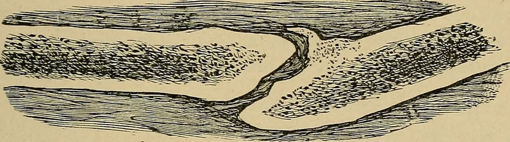 An illustration from Atlas and epitome of traumatic fractures and dislocations / by H. Helferich ; auth. tr. from the German, ed. by Joseph C. Bloodgood., 1902, leaf 77