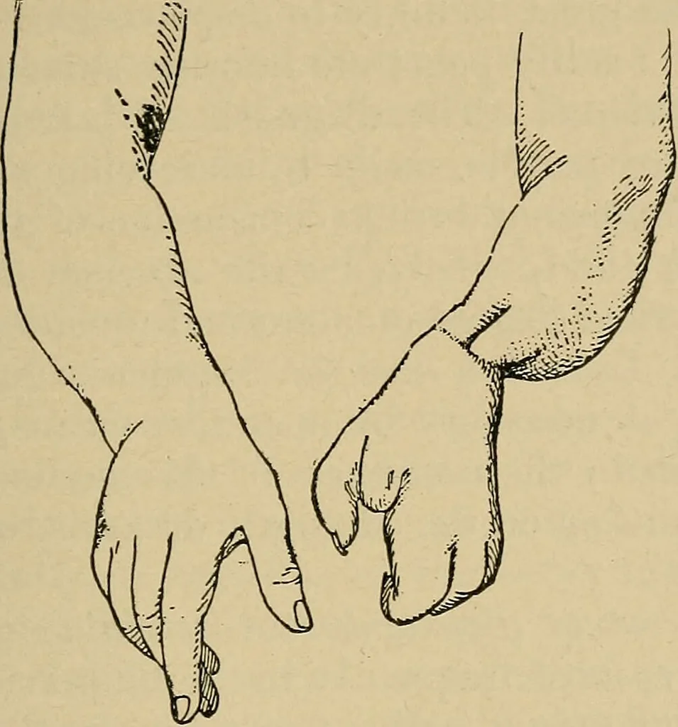 An illustration from Atlas and epitome of traumatic fractures and dislocations / by H. Helferich ; auth. tr. from the German, ed. by Joseph C. Bloodgood., 1902, leaf 79